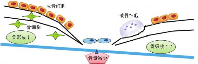 港大研究发现骨质疏松药或有助降低患认知障碍症风险
